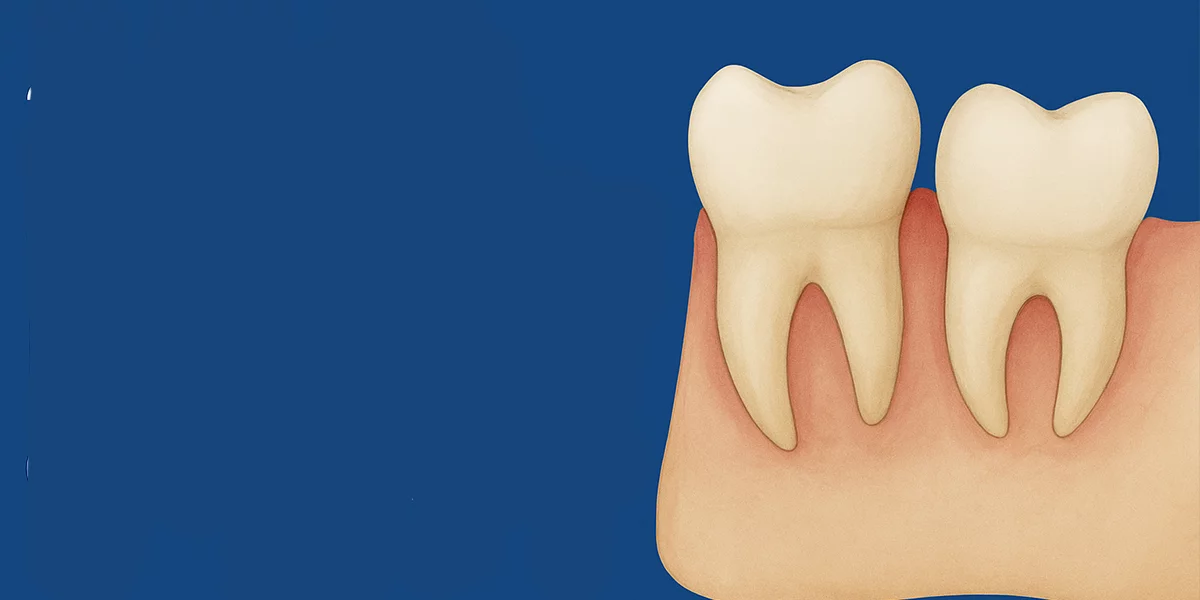 Biseach na gcliathán eagna i Bursa: An gá do gach gcliathán eagna a bhaint?