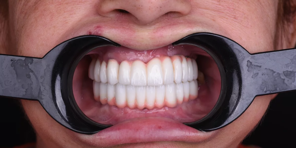 Full Mouth Restoration in Turkey: Regain Your Confidence