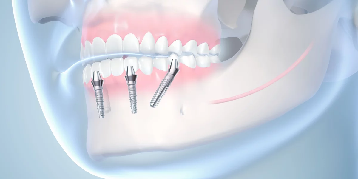Heilung & Erholung nach All-on-4