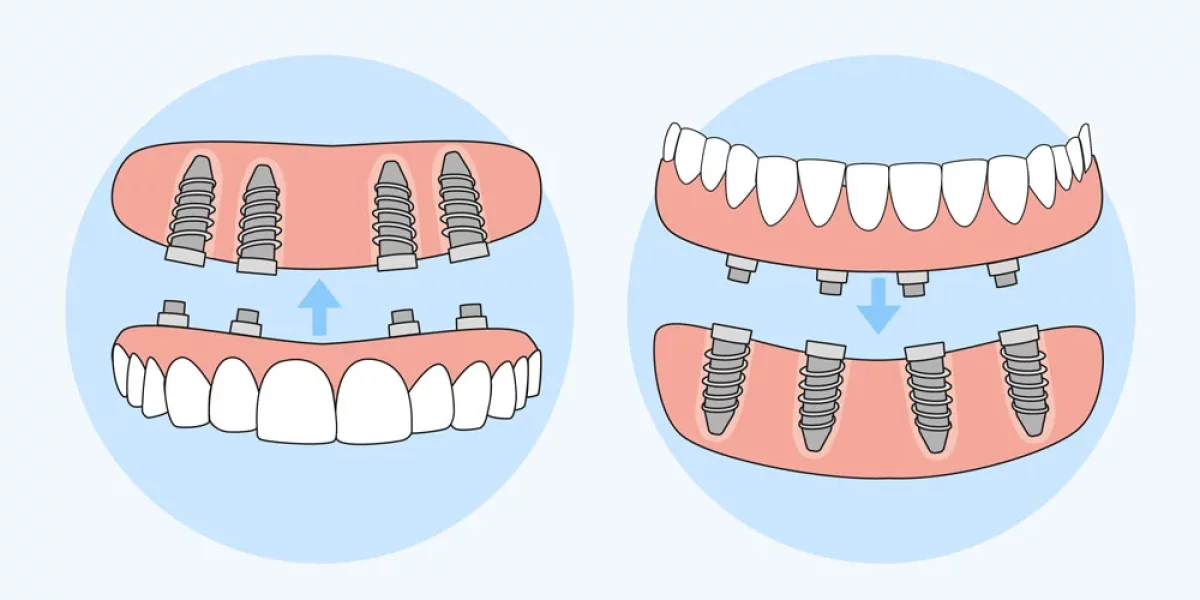 Herstel Je Glimlach met All-on-4 Tandheelkundige Implants in Bursa – Een Levensveranderende Oplossing van Milim Dental