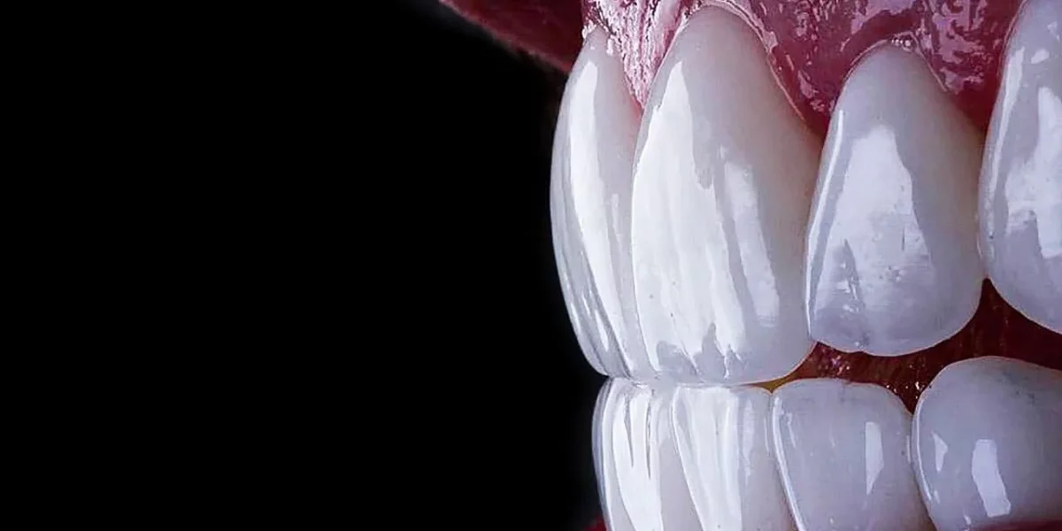 Shine Like a Star: Hollywood Smile with E-Max Veneers at Milim Dental in Bursa