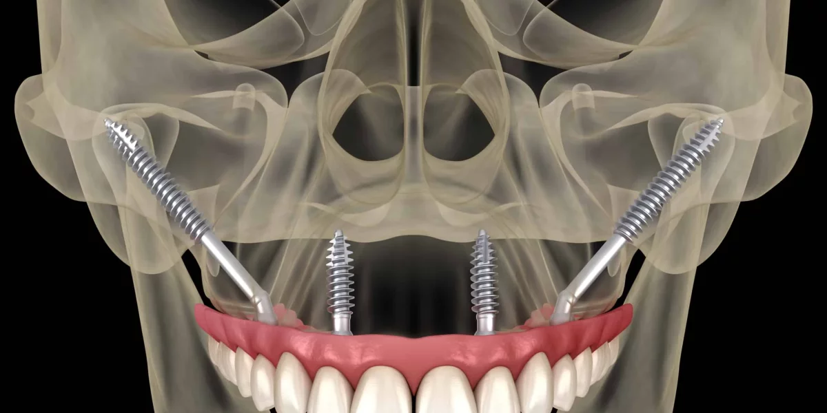 The Advantages of All-on-X for Patients with Bone Loss