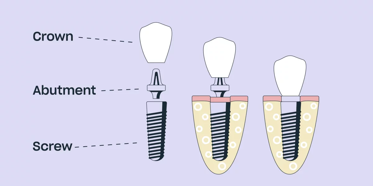 The All-on-X Procedure: Step-by-Step Guide