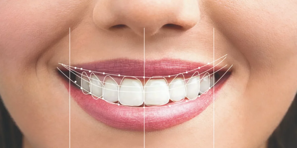 The Hollywood Smile Makeover Process: What to Expect