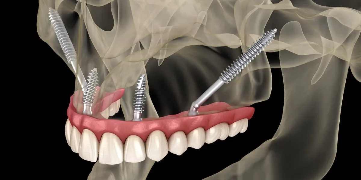 Zygomatische Implantate: Operations- & Erholungsprozess im Überblick