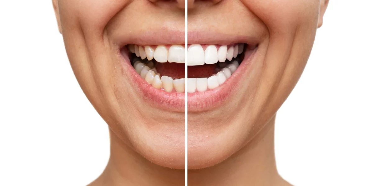 What Are Veneers and How Can They Transform Your Smile?
