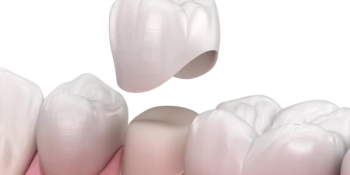 What Are Zirconium Crowns and Why Are They So Popular?