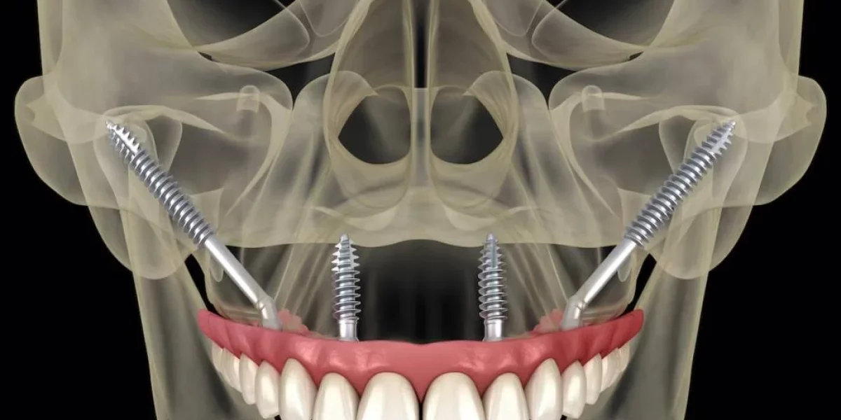 Πώς οι ζυγωματικοί εμφυτεύσεις διαφέρουν από τους παραδοσιακούς εμφυτευτές

