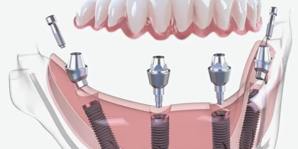What is All-on-X and How Does It Differ from All-on-4?
