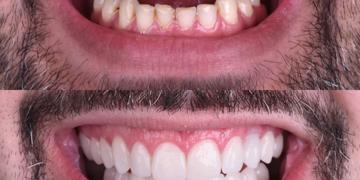 What is Hollywood Smile and How Can It Transform Your Appearance?