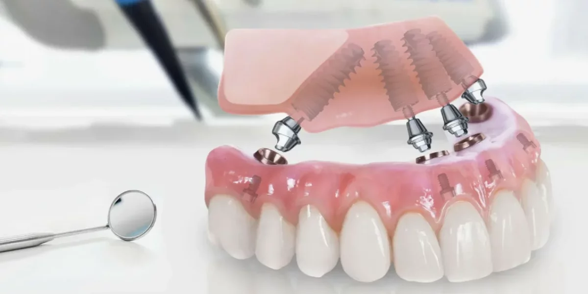 Какво е техниката All-on-4?