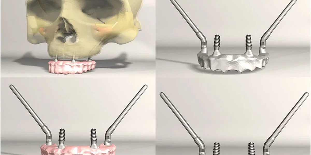 Lorsque les implants dentaires semblent impossibles, les implants zygomatiques sont la solution – uniquement chez Milim Dental, Bursa