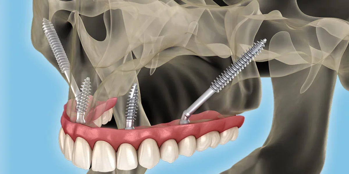 Zygomatic Implants: The Last Hope for Severe Bone Loss – Milim Dental’s Expertise in Turkey