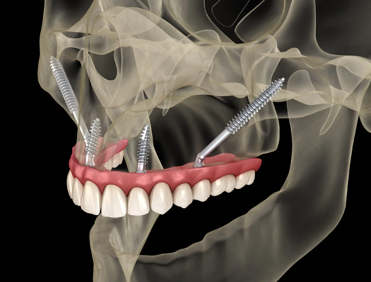 Zygomatic Implant Procedure: Surgery & Recovery Explained