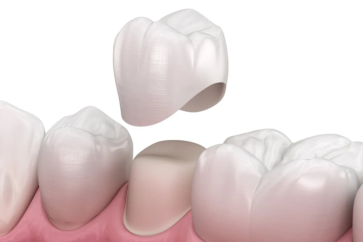What Are Zirconium Crowns and Why Are They So Popular?