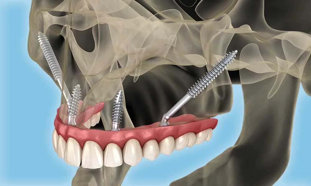 Zygomatische Implantate: Die letzte Hoffnung bei schwerem Knochenschwund – Milim Dentals Expertise in der Türkei
