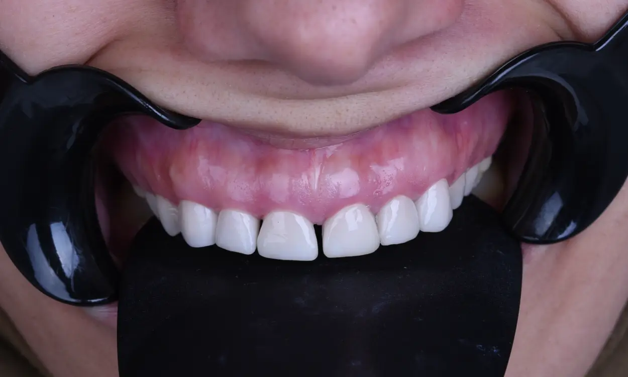 Before