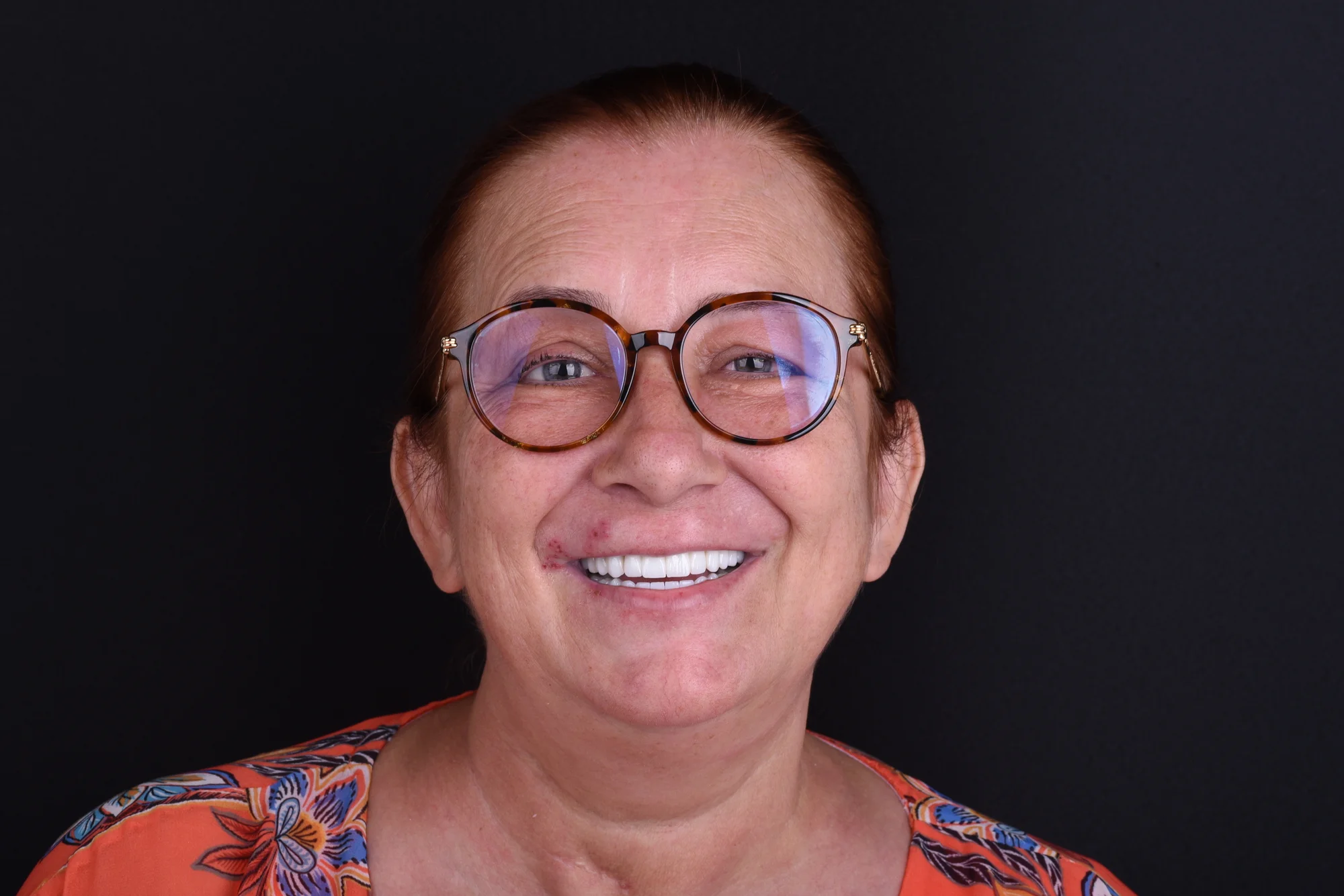 blog-todo-sobre-x-hospital-dental-milim